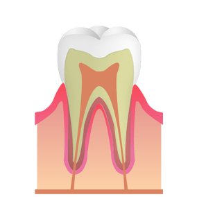 ごく初期段階のむし歯
