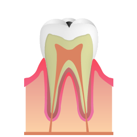 初期段階のむし歯