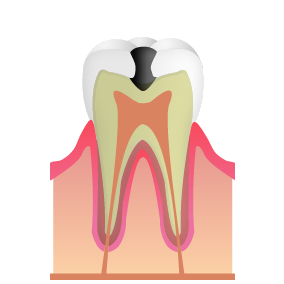 象牙質のむし歯