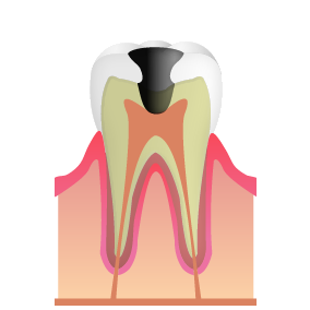 神経まで達したむし歯