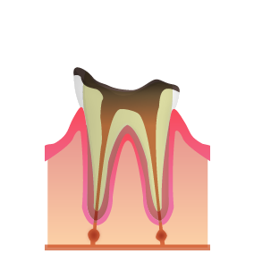 最終段階のむし歯
